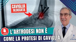 LA ARTRODESI DI CAVIGLIA SICURAMENTE NON E’ COME LA PROTESI DI CAVIGLIA  Dott Andrea Scala [upl. by Krista]