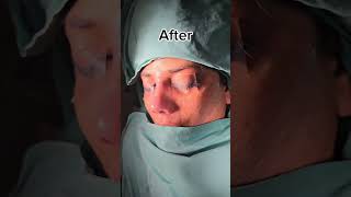 Revision Rhinoplasty [upl. by Anilak]