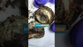 पित्ताशय की पथरी  लक्षण कारण और इलाज  Gallbladder stone Treatment  doctor pain shorts [upl. by Minabe]