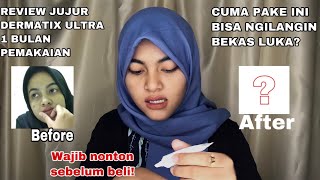 REVIEW DERMATIX ULTRA UNTUK MENGHILANGKAN BEKAS LUKA DALAM WAKTU 1 BULAN [upl. by Jaal]