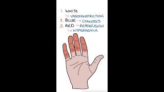 Raynauds Disease medicine rheumatology [upl. by Noroj730]