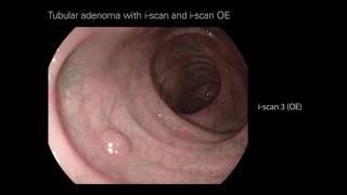 Tubular Adenoma with iscan and iscan OE 1  LGI [upl. by Burman823]