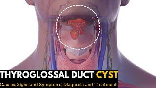 Thyroglossal Duct Cyst Causes Signs and Symptoms Diagnosis and Treatment [upl. by Mahtal287]