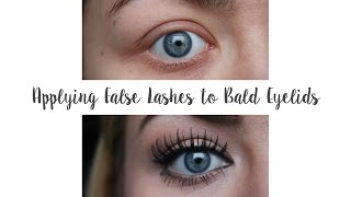 Applying False Lashes to Bald Eyelids Trichotillomania  G Beauty [upl. by Adlesirk440]