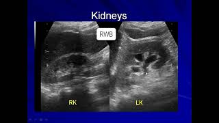 Transitional Cell Carcinoma Urothelial Carcinoma of the Urinary Bladder [upl. by Nallad]