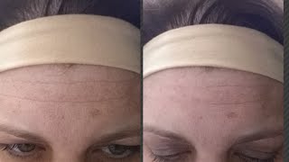 Crazy Before and After instantly ageless Back to Before Forehead Wrinkle [upl. by Urbani]