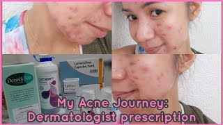 My Acne Journey Lymecycline Capsules Epiduo Gel Dermol 500 amp Cetraben Lotion  Gel Pines [upl. by Ybhsa]