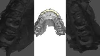 Anterior WaxUp Design dentistry [upl. by Asabi]