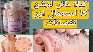 Calamine Lotion Uses  Anti Allergic Lotion  Psoriasis  Calamine Lotion Side Effects in UrduHindi [upl. by Fredek722]