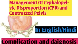 Management Of Cephalopelvic Disproportion CPD amp Contracted Pelvis II Nightingale Nursing Nursing [upl. by Fayina773]