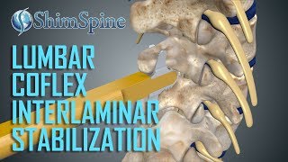 Lumbar Coflex Interlaminar Stabilization Surgery [upl. by Rennerb]