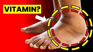 1 Vitamin to Eliminate Swelling in Feet and Legs  HealthQuest [upl. by Amsirac256]