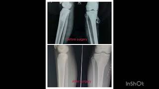 BONETUMOR REMOVALOSTEOCHONDROMAJABISETTYHOSPITALADVANCEDCENTERFOR KNEREPLACEMENTARTHROSCOPYkhmm [upl. by Dorcia188]