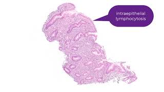 Lymphocytic gastritis [upl. by Ahsinit892]