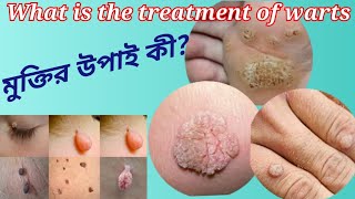 different types of warts and how to treat them warts varuca vulgaris mosaic minoxidil [upl. by Giles]