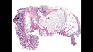 Adenomatous polyp with epithelial displacement forming a mucin pool at the polyp base [upl. by Flanigan]