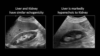 GI Imaging  Hepatic Steatosis and Cirrhosis [upl. by Orfield]