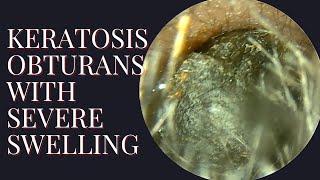 KERATOSIS OBTURANS With Severe Ear Canal Swelling [upl. by Seena104]