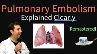 Pulmonary Embolism Remastered  Pathophysiology Symptoms Diagnosis DVT [upl. by Clute]