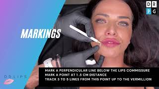 iLips® technique how to lift lips commissure during lips filler [upl. by Iveksarap]