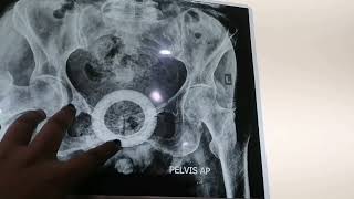 Xray of Pelvis  Vaginal Pessary Ring xray radiology [upl. by Kalb399]