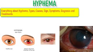 Hyphema Sign Symptoms Causes Risk factor and Treatment Everything is covered in this video [upl. by Yanahs636]