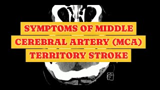 Symptoms of MCA Stroke [upl. by Inama660]