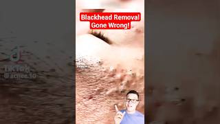 TERRIBLE BLACKHEAD REMOVAL  Shocked At This One shorts [upl. by Jae]