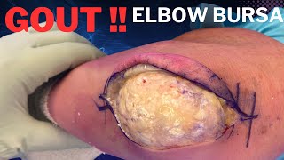 Elbow Olecranon Bursitis Gout Treated in 3 minutes [upl. by Latham]