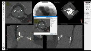 3Mensio CT precase planning ValveinValve TAVR in PerimountMagna Surgical Aortic Valve SAV [upl. by Llertal103]