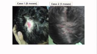 Dermatofibrosarcoma protuberans recidivante respuesta a imatinib [upl. by Anehs]