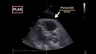 Pericardial Effusion with Doppler Echocardiographic criteria for Tamponade [upl. by Anytsirhc619]