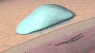 The Science behind Personal Microderm and microdermabrasion with animation [upl. by Langer47]