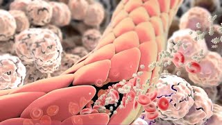 Inflammation Immune Response to Tissue Injury or Infection [upl. by Sitruk]