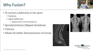 Spinal Fusion Separating Myths from Facts w Dr Eamonn Mahoney  Northern Arizona Orthopaedics [upl. by Malonis]