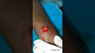 Papilloma surgery with agnikarma papillomaagnikarmaayurvedaforall [upl. by Yelnik98]