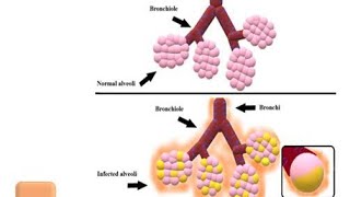 Pathophysiology of Pneumonia [upl. by Titania]