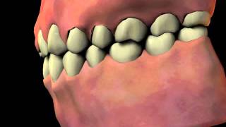 Gingival Hyperplasia [upl. by Gonta]