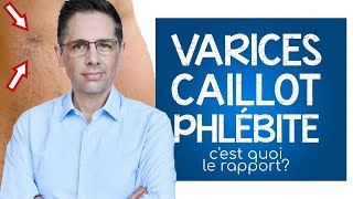 Varices caillot et phlébite cest quoi le rapport [upl. by Nuahsal]