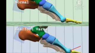 Comparison of Normal Gait to Rearfoot Varus Gait [upl. by Kazimir]