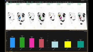 Lesion tracking through time in Hermia Multimodality Viewer [upl. by Dwaine41]