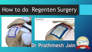 How to do a Regenten Rotator Cuff Repair [upl. by Araet162]