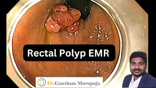 EMR Rectal polyp just above dentate line Dr Gautham Morupoju Best Gastroenterologist [upl. by Arikihs]