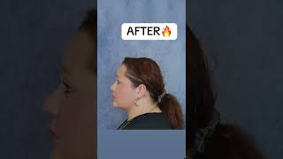 INSANE CHIN LIPO RESULTS 🔥 chinlipo glowup beforeandafter plasticsurgery chinliposuction [upl. by Nimad457]