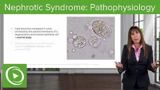 Nephrotic Syndrome Pathophysiology with Case– Nephrology  Lecturio [upl. by Eli]