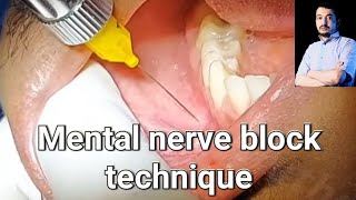 Local Anesthesia Mental Nerve block technique mandibular anesthesia Techniques dentistry [upl. by Anala]