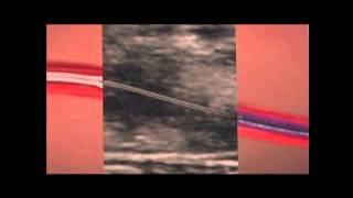 What is endovenous ablation [upl. by Onairpic]