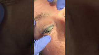 Would you do this to protect eyes before laser treatment on eyelids dermatologist [upl. by Jecho63]