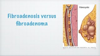 Fibroadenosis vs fibroadenoma medicohelpcom [upl. by Enilamme907]