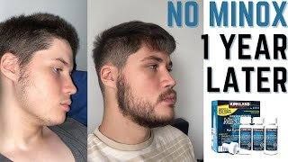 1 Year After STOPPING Minoxidil  Have I Lost Gains [upl. by Aicila]